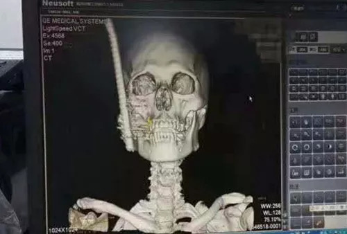 惊魂！汕头骑行男子突遭钢珠袭击，警方介入调查引关注